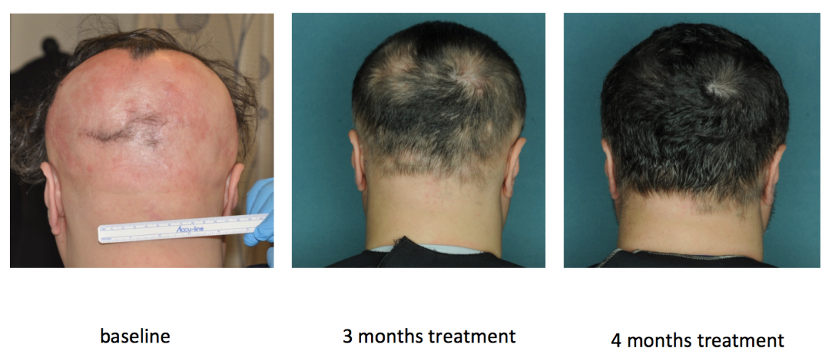 Hair regrowth after ruxolitinib treatment of a patient with alopecia areata.