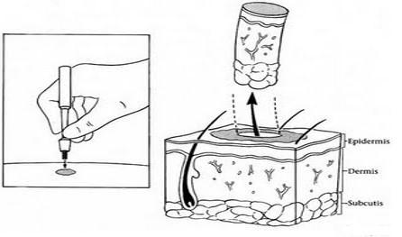 Skin biopsy procedure